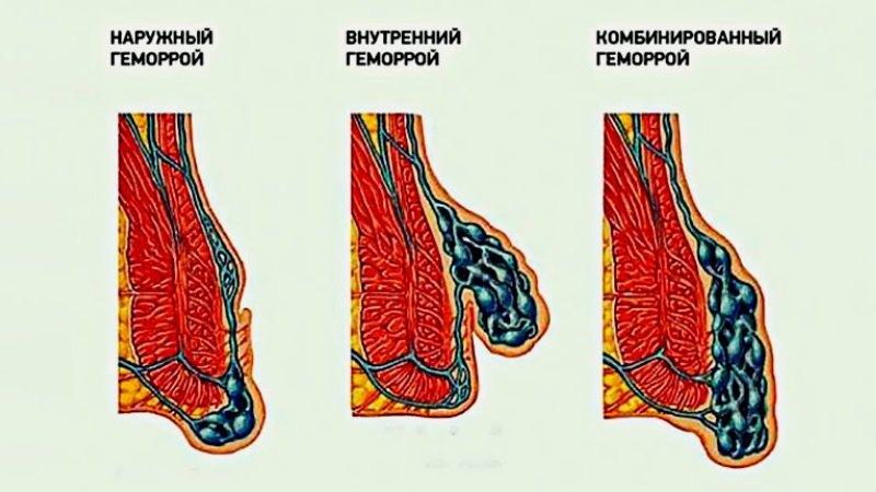 как принимать таблетки детралекс при геморрое отзывы