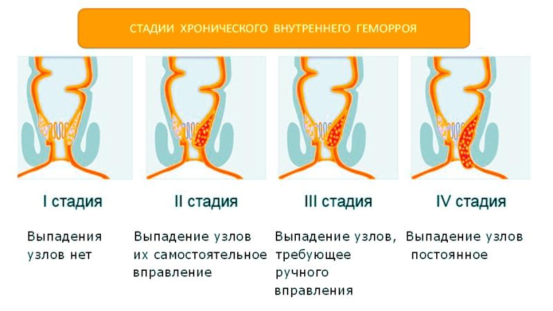 как убрать шишки геморроя