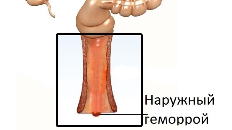 как выглядит геморрой у женщин фото и как лечить