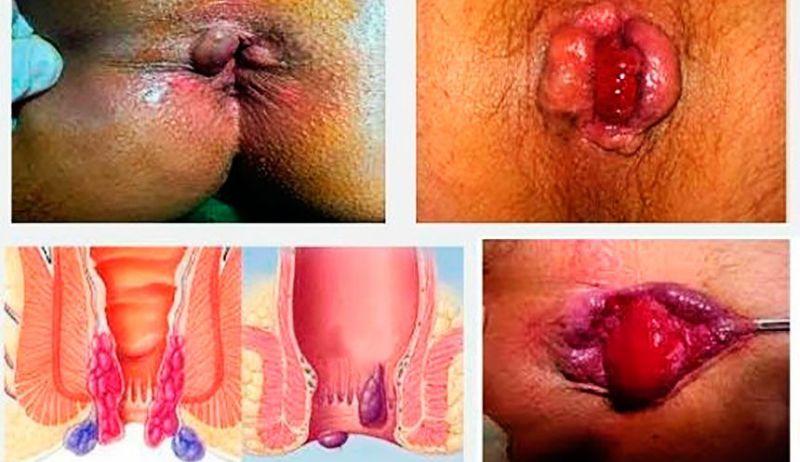 как выглядит геморрой у женщин после родов фото