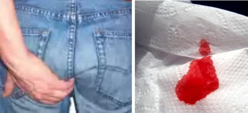 фото геморроя у женщин наружного