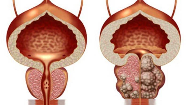 как выглядит простатит