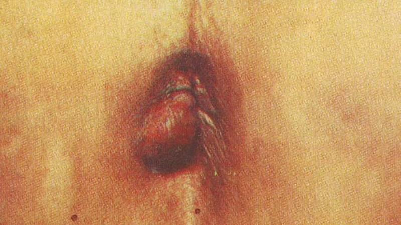 какую мазь можно от геморроя при беременности