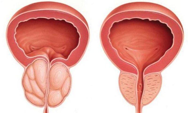 китайский пластырь урологический для лечения простатита