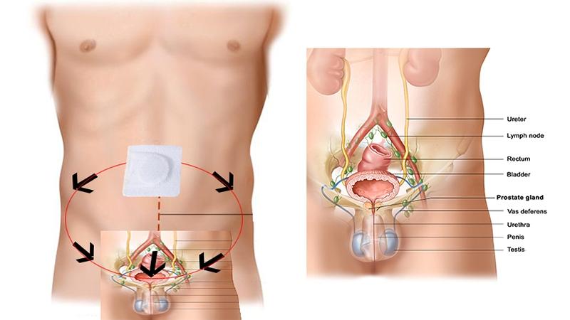 лейкопластырь китайский от простатита