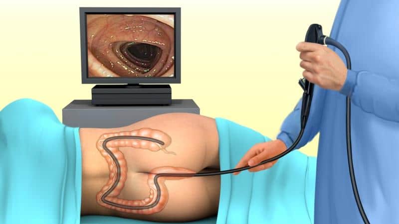 воспаление кишечника симптомы и лечение колита