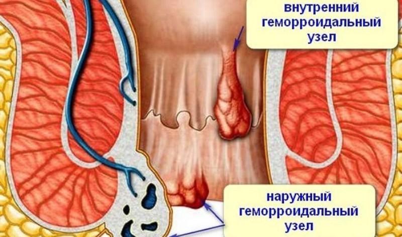 лечения геморроя по Кондакову