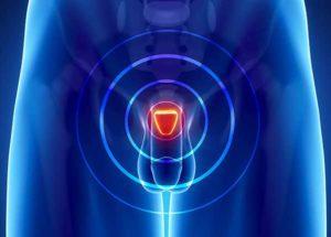 Что такое когнестивный простатит и его лечение