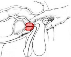 Что такое когнестивный простатит и его лечение