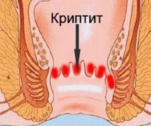 Что такое криптит прямой кишки и как его лечить