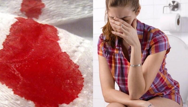 кровь после дефекации без боли у женщин причины