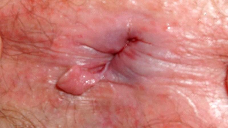 на бумаге кровь после дефекации