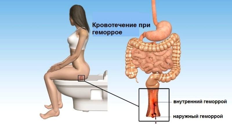 кровь алая при дефекации