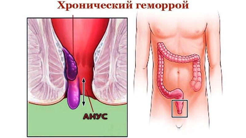 Лечение геморроя лавровым листом: рецепт и отзывы