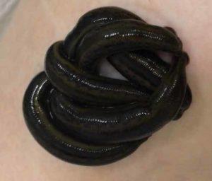 лечение геморроя гирудотерапией