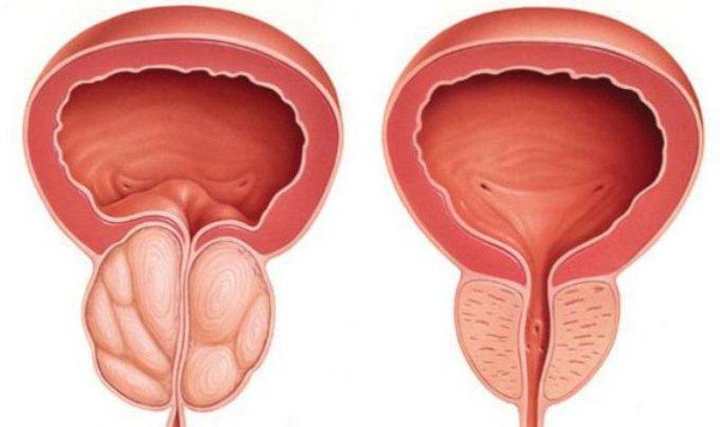 можно ли делать массаж простаты при геморрое