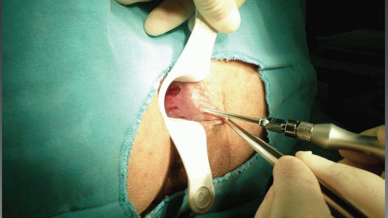 удаление геморроя лазером отзывы после операции