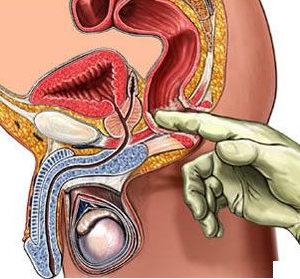 хронический простатит лечение народными методами