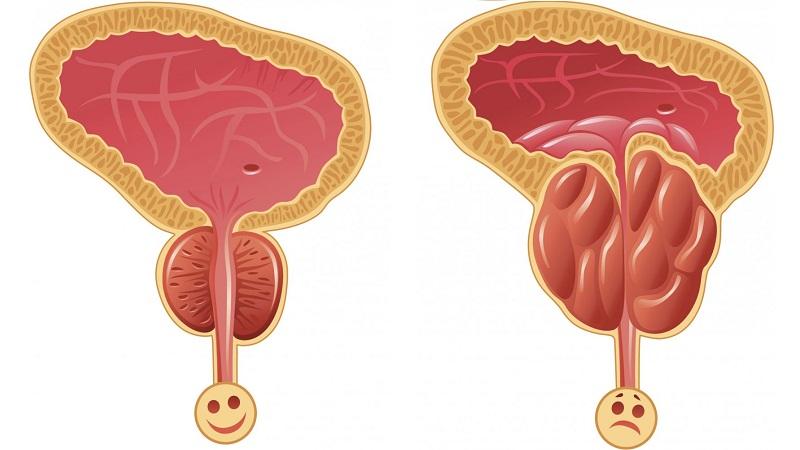 мочеиспускание при простатите