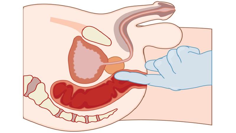 как прощупывают простату
