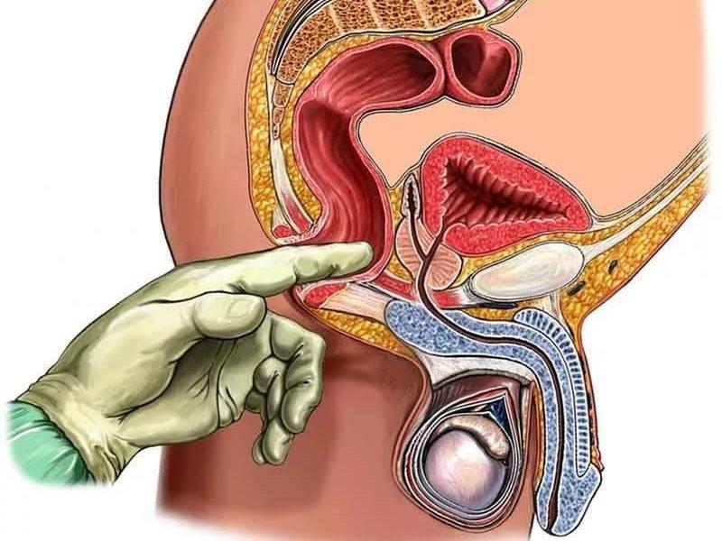 Лечение хронического калькулёзного простатита