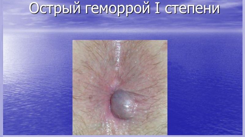 лечение хронического геморроя