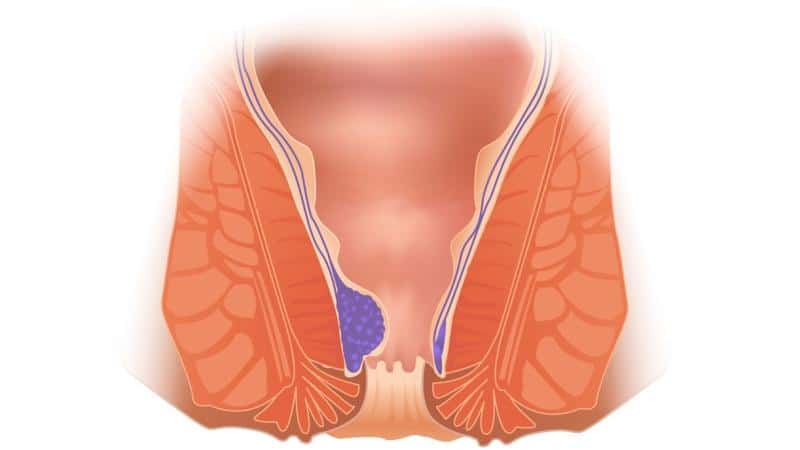 симптомы внутреннего хронического геморроя