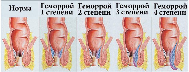 как лечить хронический геморрой