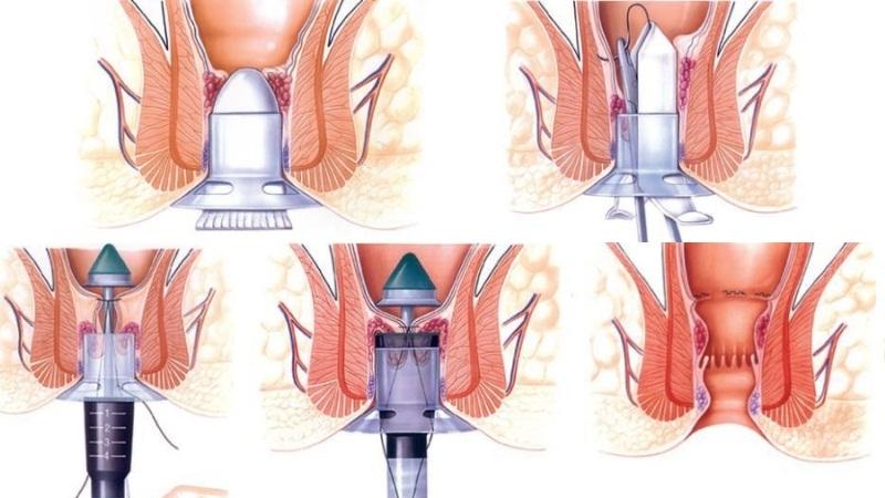 обострение хронического геморроя