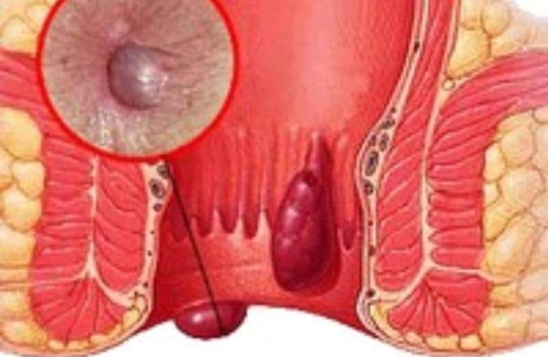 лечение геморроя