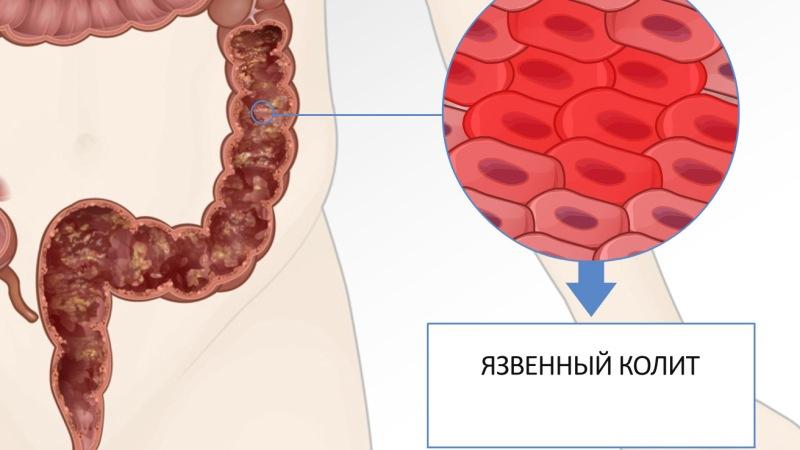 лечение катарального колита кишечника