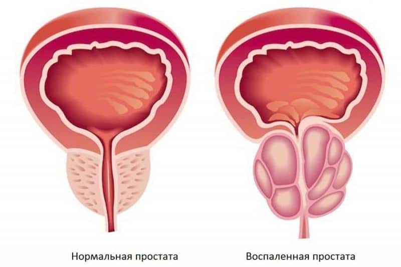 лечение начальной стадии простатита