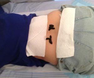 Гирудотерапия в лечении простатита: инструкция и отзывы