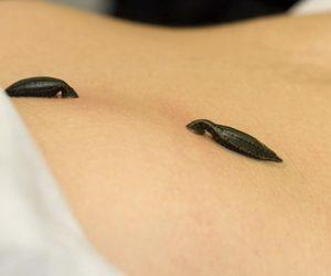 Гирудотерапия в лечении простатита: инструкция и отзывы