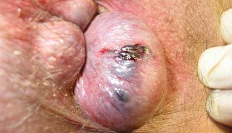 лечение препаратами острого геморроя