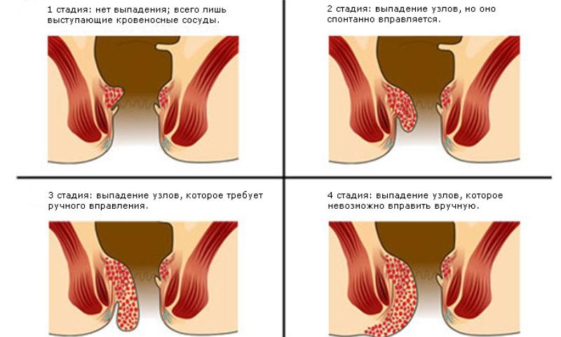 как лечить геморрой острый