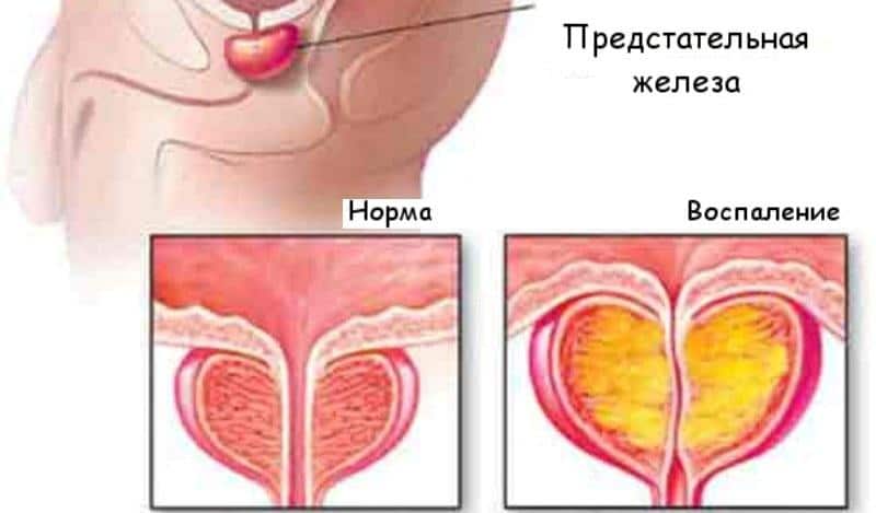 Имбирь при простатите: рецепт для лечения простатита и отзывы