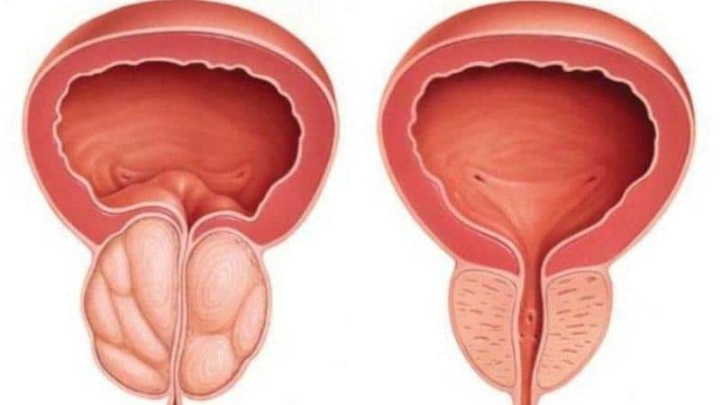 лечение простатита народными средствами самые эффективные