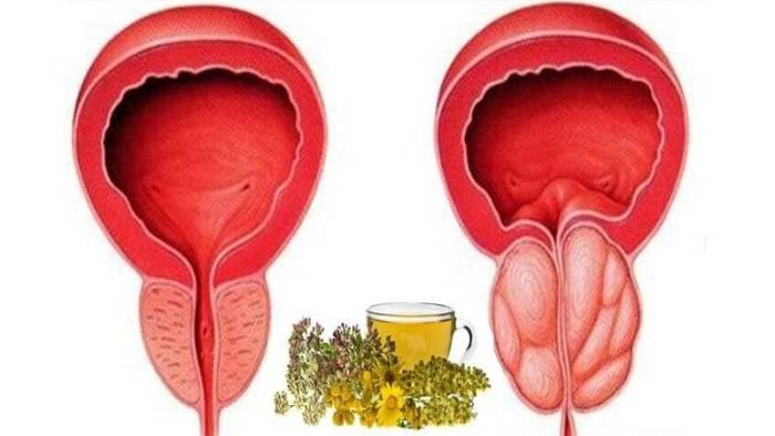 народные методы лечения простатита