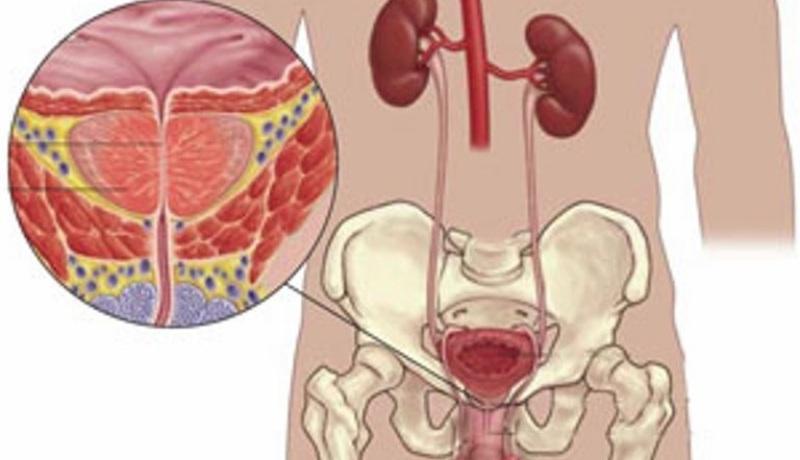 травы от простатита самые эффективные