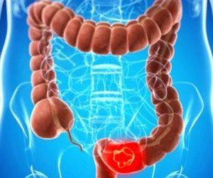 Рак прямой кишки: лечение народными средствами