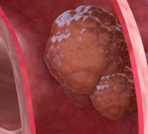 Рак прямой кишки: лечение народными средствами