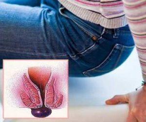 тромбоз геморроидального узла фото