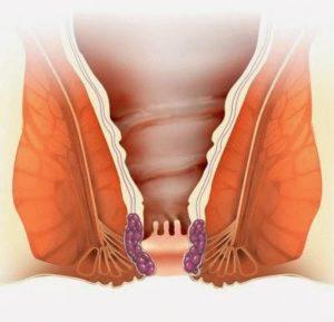 тромбоз геморроидального узла симптомы