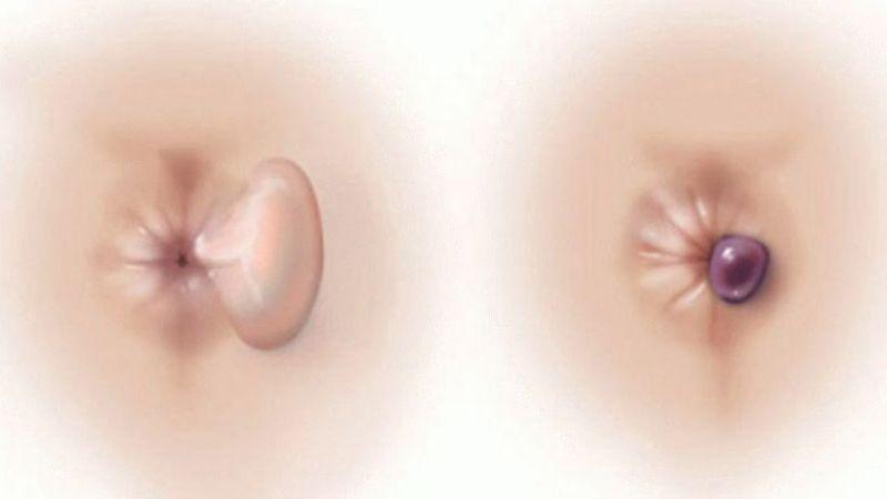 Как в домашних условиях вылечить наружный геморрой