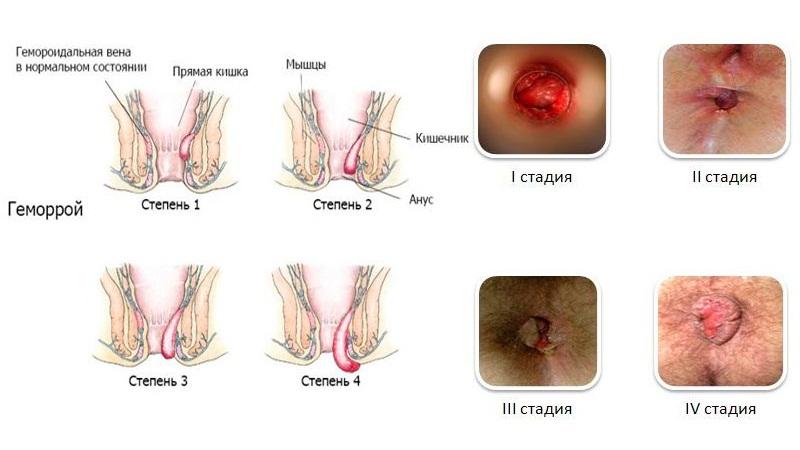 воспаление геморроя как снять воспаление в домашних условиях