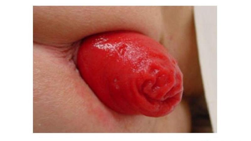 Выпадение прямой кишки: лечение в домашних условиях