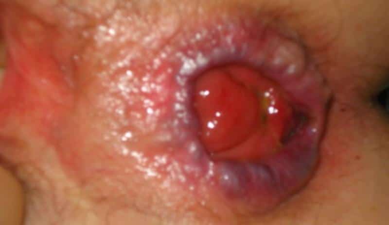 Выпадение прямой кишки: лечение в домашних условиях