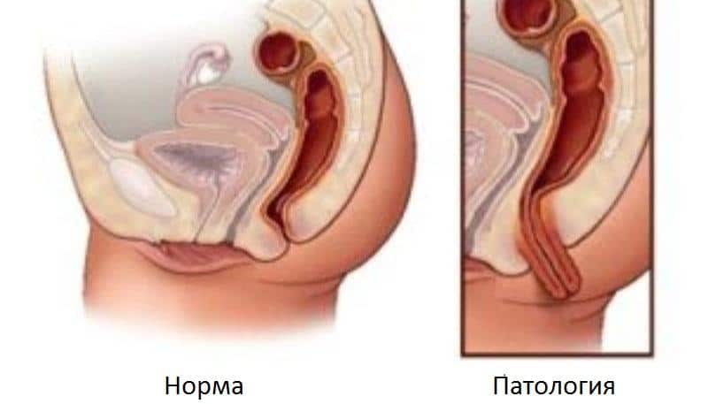 Выпадение прямой кишки: лечение в домашних условиях