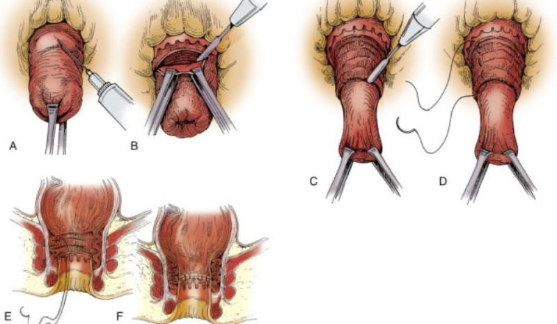 свечи при выпадении прямой кишки